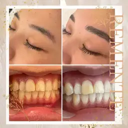 【今月限定１名様のみ】3点同時施術可能🌹　ハイドラ＋ホワイトニング＋骨格診断ハリウッドブロウ🌹　歯科医師監修の液剤