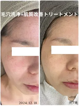 毛穴洗浄+トリートメント　カウンセリング込120分　【通常11,000円】​〜​毛穴の汚れ、開きやくすみ等が気になる方​〜​