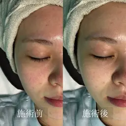 【ミニモ学割U24🏫】光フェイシャル＋顔脱毛(全顔)  化粧ノリ抜群◎ ¥3,000