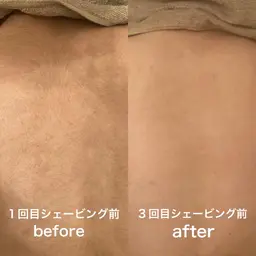 夏に大人気♥️背中＋うなじ脱毛✨シェービング無料🎶