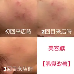☀️おすすめNo,3☀️【肌荒れ改善特化メニュー】W美容鍼（40本）＋ヘッドマッサージ＋首肩背中マッサージ