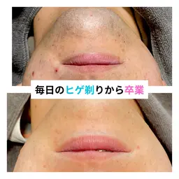 ヒゲ剃るのが面倒‼️そんな男性はヒゲ脱毛デビュー🌸