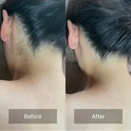 美肌脱毛Ｌパーツ　　ヒジ上、ヒジ下、ヒザ上、ヒザ下、背中上、背中下、おなか、胸、おしり、うなじの1箇所