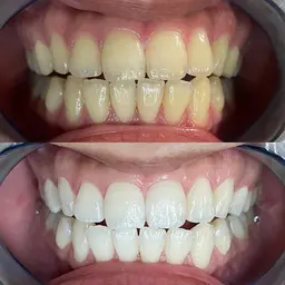 【初めての方専用💎】セルフホワイトニング体験1,000円🦷✨15分照射で白さ実感◎