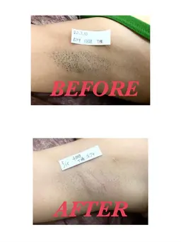 ❤️【両ワキ】脱毛モニター募集🎀3回1,800円❤️脱毛の定番箇所🥰