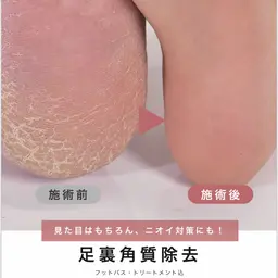 【🛁フット角質ケア】足裏 角質ケア（フットバス＆保湿付✨)