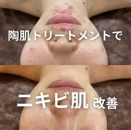 新規ミニモ限定【ニキビケア専用】ハーブピーリング＋小顔矯正