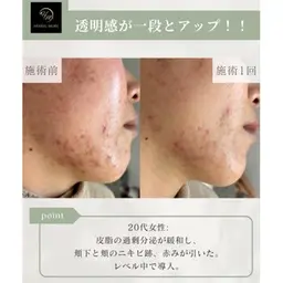 【ニキビ/凸凹肌が気になる方】剥けるハーブピーリング＋鎮静パック