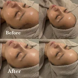 【美白】フェイシャルエステ・パック込み💆🏻‍♀️🫧圧倒的な透明感と美白ケアで夏の日焼けお疲れ肌をリセット🌈
