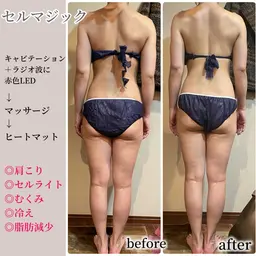 【痩せたい方に】セルライトマジック​〜​全身​〜​