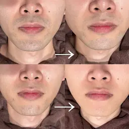 【まずはお試し🆗】men's美肌ヒゲ脱毛(顎/鼻下/頬/首/もみあげ)