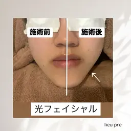 【平日限定】光フェイシャル😶‍🌫️