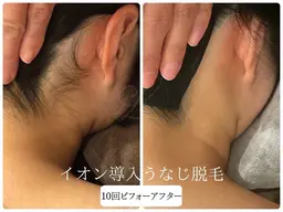【うなじ脱毛】シェービング付き💕首元正面&襟足 全照射♪理想のうなじで垢抜け🩵¥4,000→¥3,500