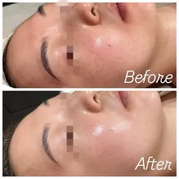 イラストリアス【美白白玉ピーリング】¥16,500→¥11,000シミ/肝斑/くすみ/透明感ケア