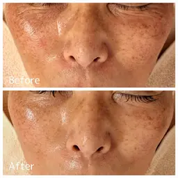 【NEW即効性最強ピーリング】水光ピール+美容液導入　50分