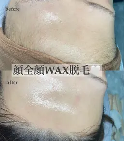艶肌wax脱毛(顔全顔)パック付き¥5500