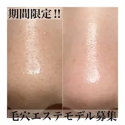 【毛穴美人コース】毛穴の黒ずみ、ざらつきにお悩みの方におすすめ‼︎