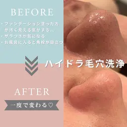 【毛穴汚れ撃退!!つるんとたまご肌に】ハイドラ毛穴洗浄☆