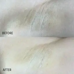 脇の黒ずみ改善ララピール　8800円➡