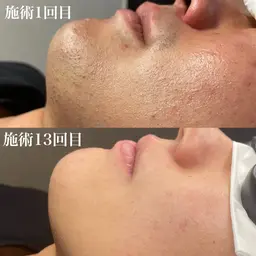 12月限定メンズ顔脱毛20回¥100000→¥65000 SALE