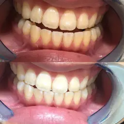✨都度払い✨🦷ホワイトニング20分×2回（計40分）🦷￥6970円🌈🌈
