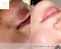 【顔◆人気No.1】剥けるハーブピーリング×鎮静パック