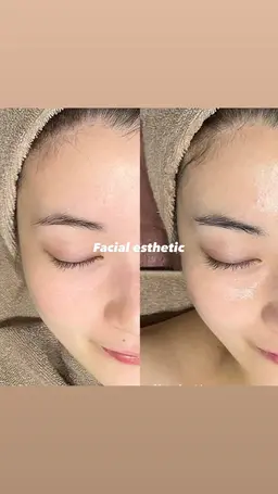 【フェイシャルエステ】エレクトロポレーション