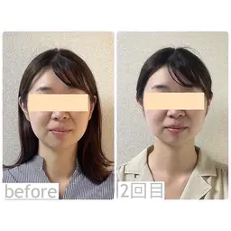 🦩丸顔のお悩みにむくみスッキリ✨痛くない小顔矯正💫【クレンジング＋小顔矯正＋保湿パック】