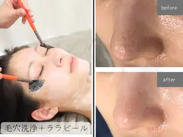 【毛穴•ニキビにお悩みの方はこちら】ララピール＋毛穴を洗浄90分　18,500円→12,800円