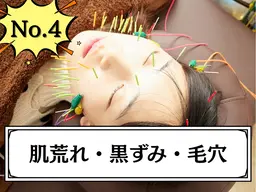 【9月限定☆ツヤ肌】美容鍼+ハーブピーリング＋毛穴洗浄 ¥16,000→¥5,980