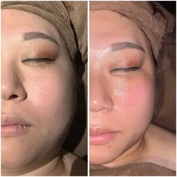 🌟【練習モデル募集】ぽにょ取り💆‍♀️ ラジオ波でスッキリ小顔✨《痛みなし・ダウンタイムなし・エイジングケア》