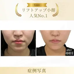 30代40代🔥引き締めx 脂肪コントロール🔥のWアプローチ！サーマナイフxスッキリ洗練小顔へ」エステ以上の効果‼️