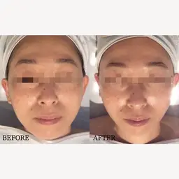 【人気No. 1⭐︎小顔/たるみ凹凸ケア】お試しサーマトリックス選べるパーツ３部位✨