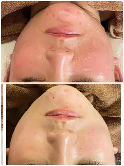 5名限定‼️小顔リフトアップ💎4000ショット💆‍♀️究極の小顔ケア✨