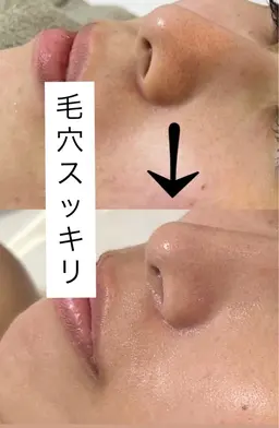 毛穴洗浄🧹✨️皮脂詰まり毛穴の黒ずみへアプローチ♪【 練習モデル】