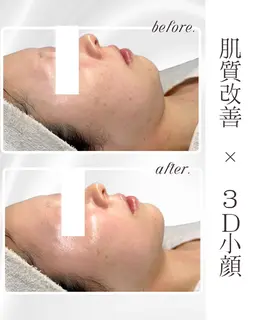 👑人気No.1👑通常¥29800→¥15,500【脂肪コントロール×ララピール】ツヤ肌×小顔が可能‼️