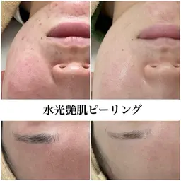 【平日限定*肌質改善】毛穴浮きや化粧ノリの悪さ*ニキビ*ざらつきに♪水光ピーリングでちゅるちゅる素肌へ🫧パック付き❤︎