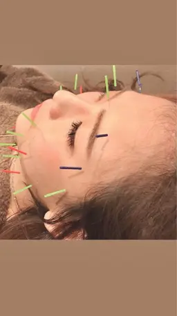 人気の美容鍼✨【ご新規様限定】