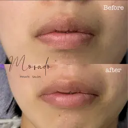 部分WAX1ヶ所(おでこ/頬/口周り/鼻毛/フェイスライン下)