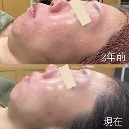 フェイシャルエステ