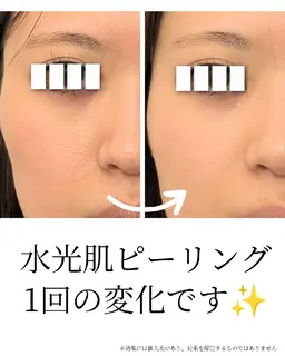 水光肌ピーリング💎剥離なし！ニキビ、毛穴、くすみのお悩みに！