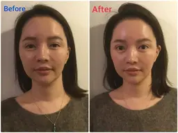 【年末キャンペーン11/15-12/30】小顔矯正ショート　2980円