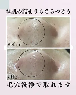 ニキビケア/くすみ/毛穴詰まり【ダウンタイムなし】毛穴洗浄