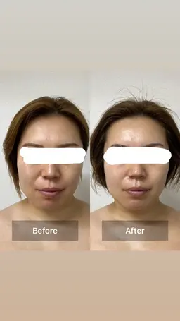 【先着2名様】速攻小顔リフクール＋美肌パック付き✨モニター価格19,800円→8800円