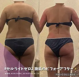 口コミ投稿で初回50%OFF◎セルライトゼロ2で一生物の健康と美を手に入れませんか？90分全身お任せコース（メンズ可）