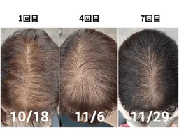 女性専用/初回体験《髪が細くなった/分け目が目立つ/頭皮が透けて見える》髪を育てる鍼＋LED