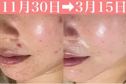 【人気NO.3/くすみ/乾燥】もちもち肌が叶う次世代ハーブピーリング