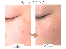 【ハリつやシミ毛穴に❣️】光フェイシャル💡✨