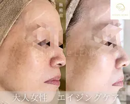 【顔◆40歳​〜​59歳限定】剥離ありハーブピーリング