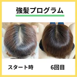 【人気No.1】強髪プログラム(ヒト幹細胞培養液110%使用)/育毛促進の効果をより高めたい方に